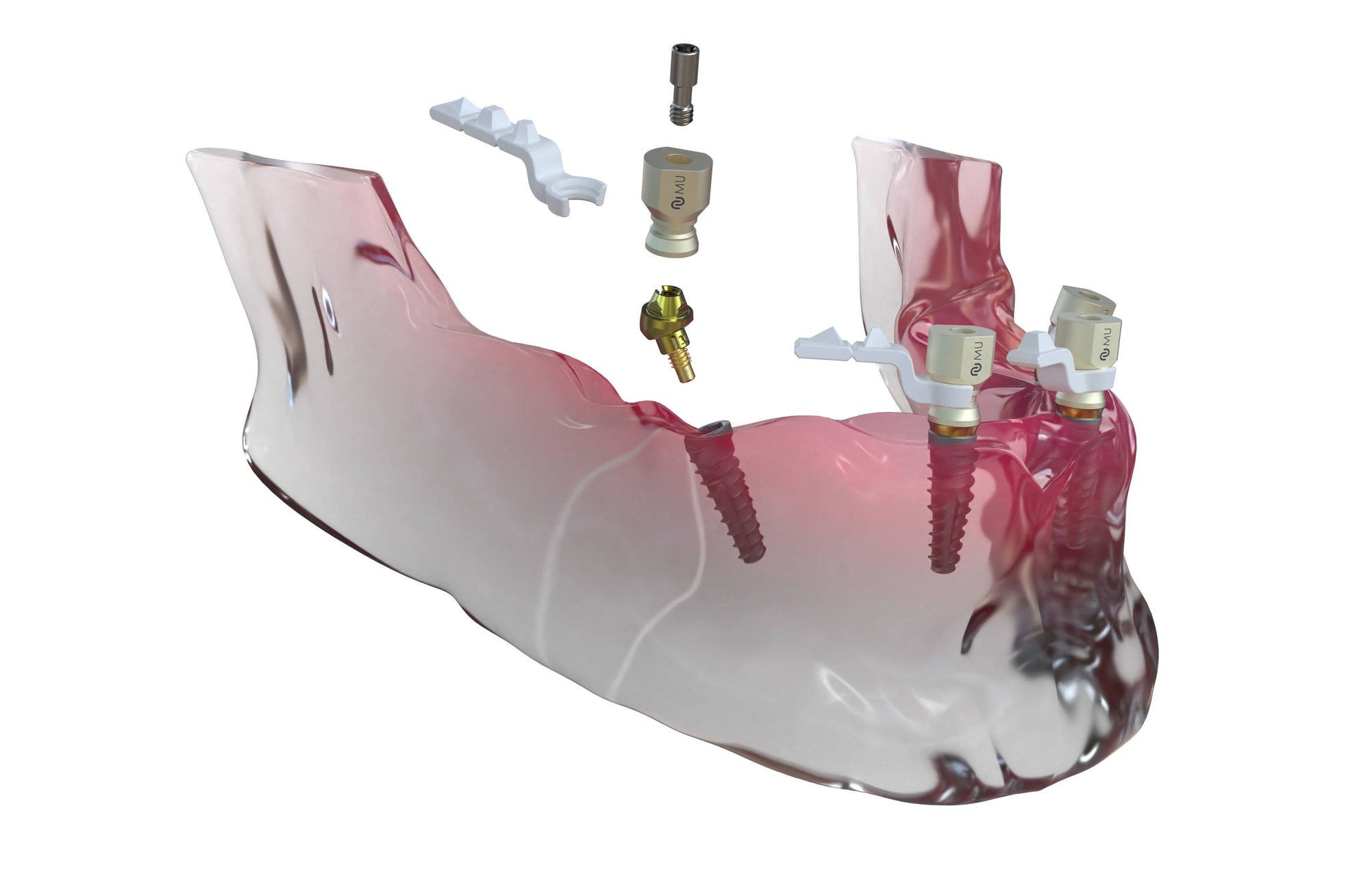 Neoss Full Arch with Scan Body