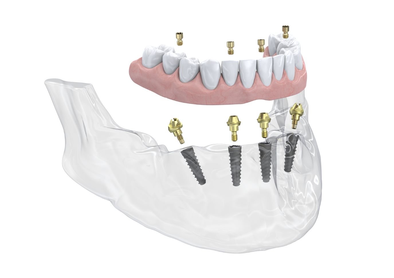 Neoss 4+ with Multi-unit abutment