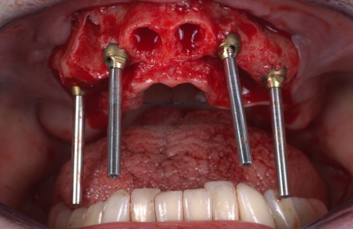 Dr. Dominic Hützen 4+ clinical case fig 10